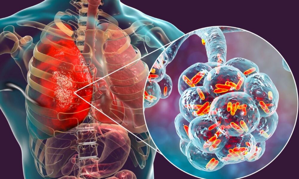 Tuberculosis: Una Amenaza Persistente para la Salud Pública Mundial