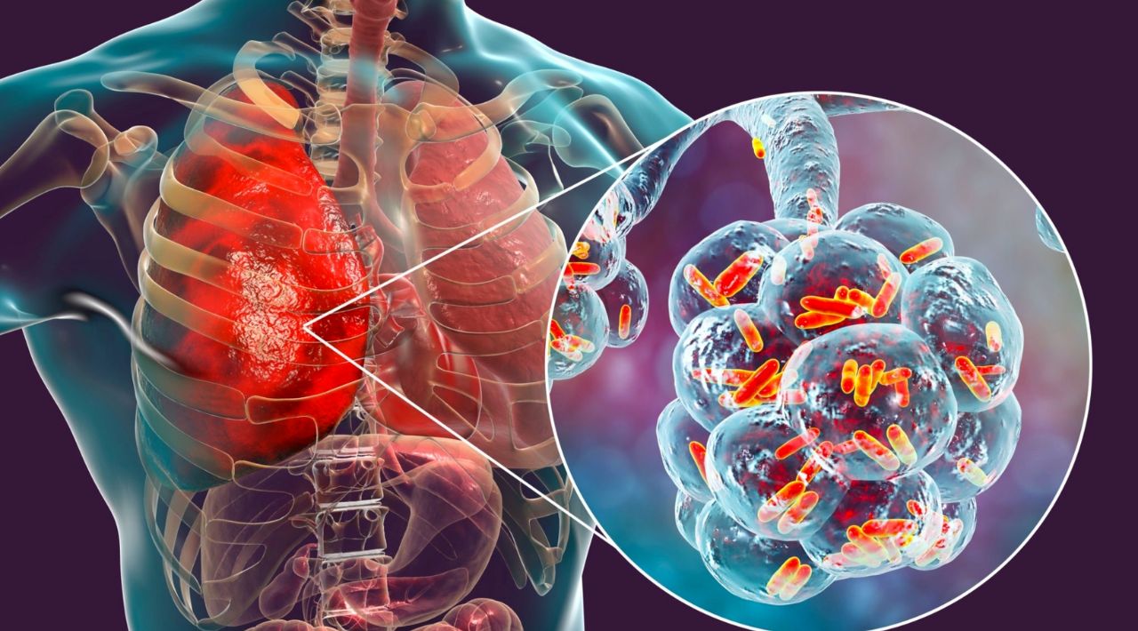 Tuberculosis: Una Amenaza Persistente para la Salud Pública Mundial