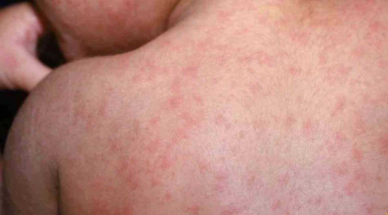 México suma 12 muertes por sarampión; Chihuahua concentra la mayoría