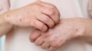 Emite Salud tercer aviso epidemiológico por sarampión; suman 2 mil 597 casos en el país