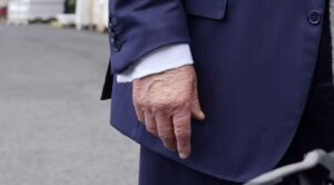 Trump es diagnosticado con insuficiencia venosa crónica