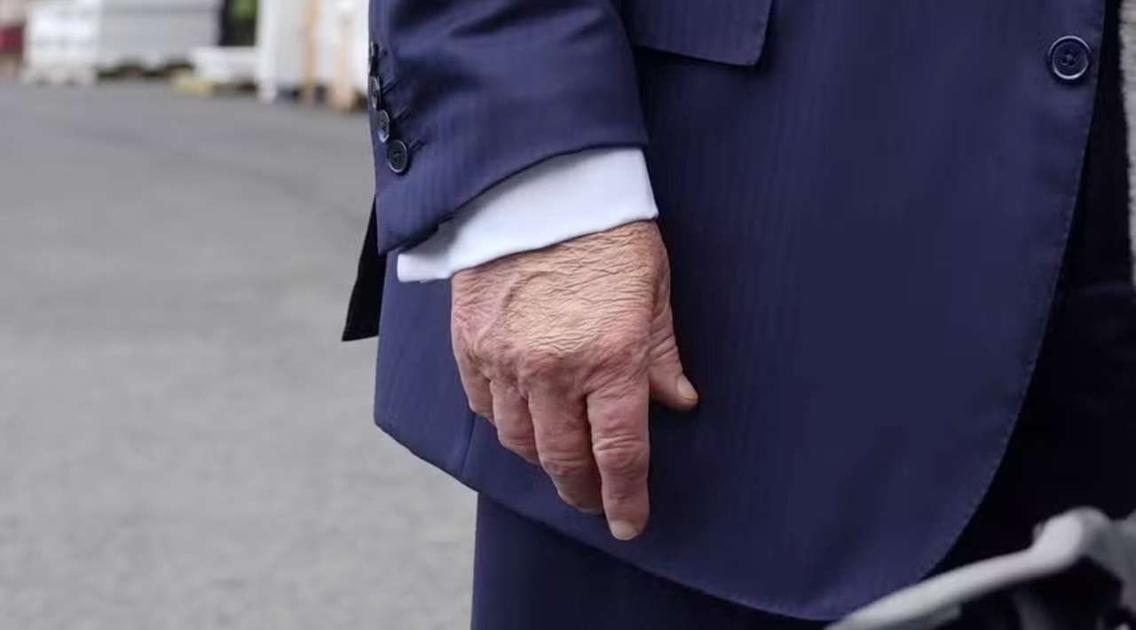 Trump es diagnosticado con insuficiencia venosa crónica