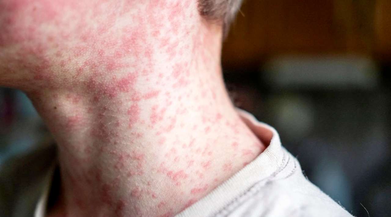 EEUU rompe récord de contagios de sarampión en 2025