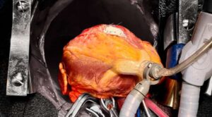 Exitosa Cirugía de Reparación de Ruptura Ventricular en el HRAE”Centenario de la Revolución Mexicana” del ISSSTE en Morelos