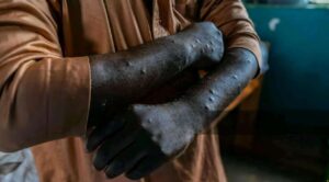 OMS levanta emergencia sanitaria internacional por viruela del mono