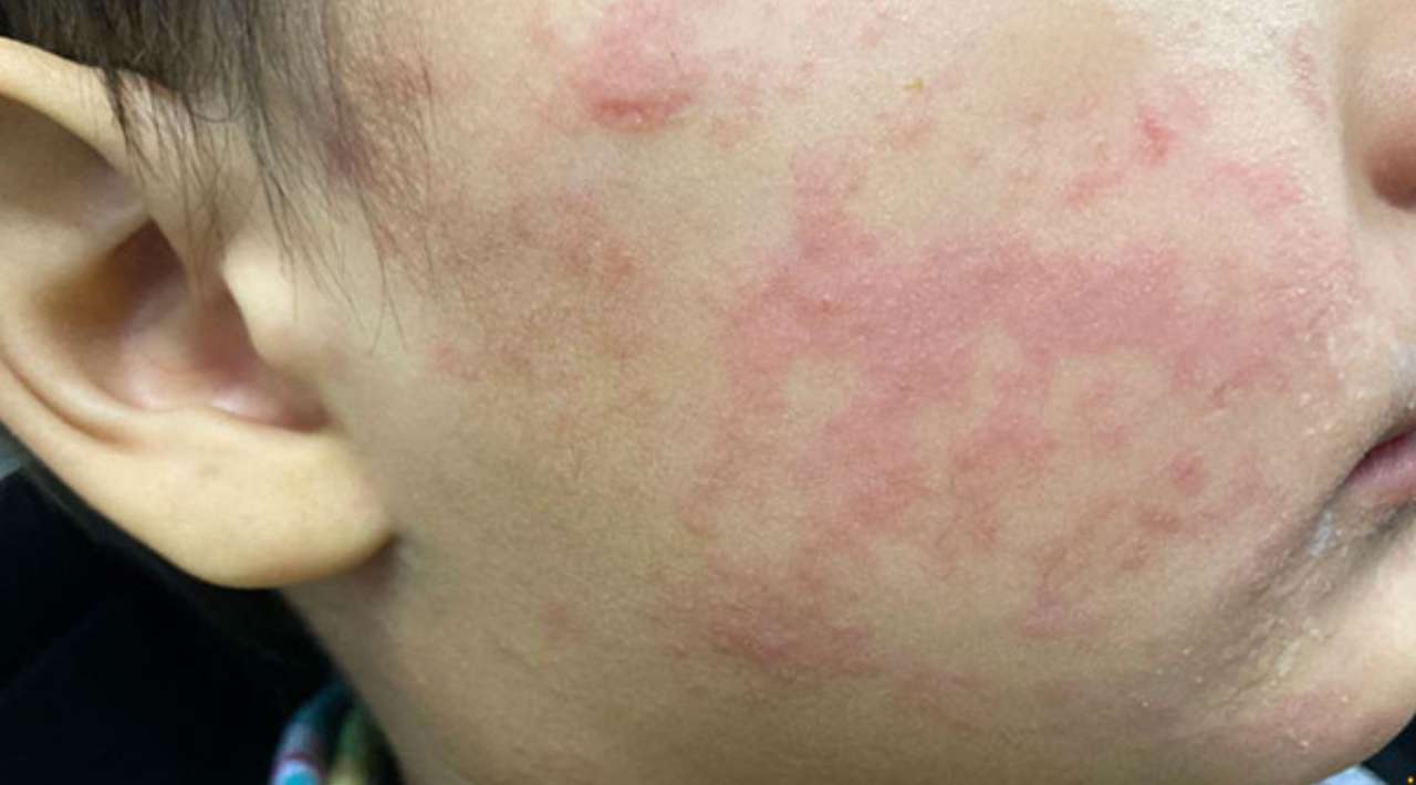 Casos de sarampión se extienden a 25 estados; suman 4 mil 849 contagios en el país