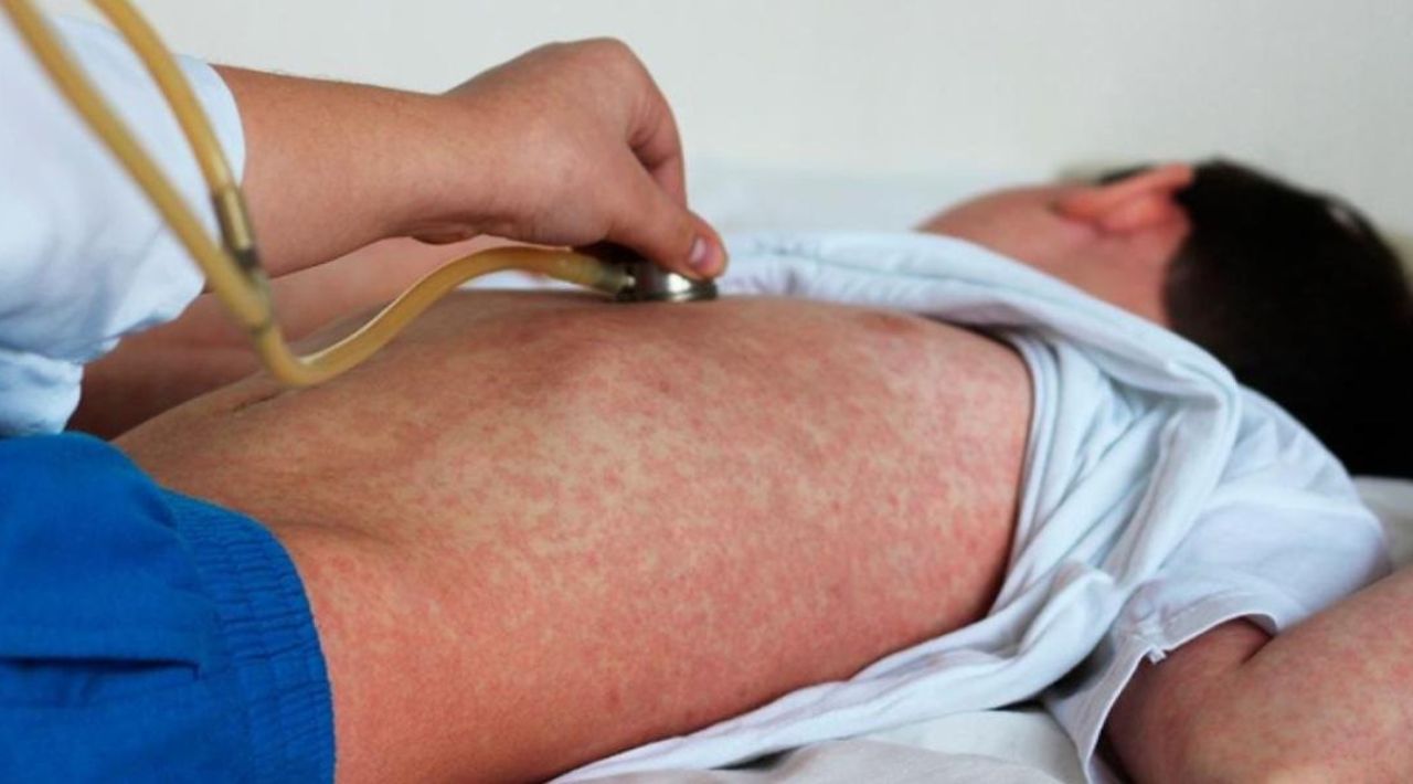 Canadá pierde certificación de país libre de sarampión; Organización Panamericana de la Salud advierte riesgo para México