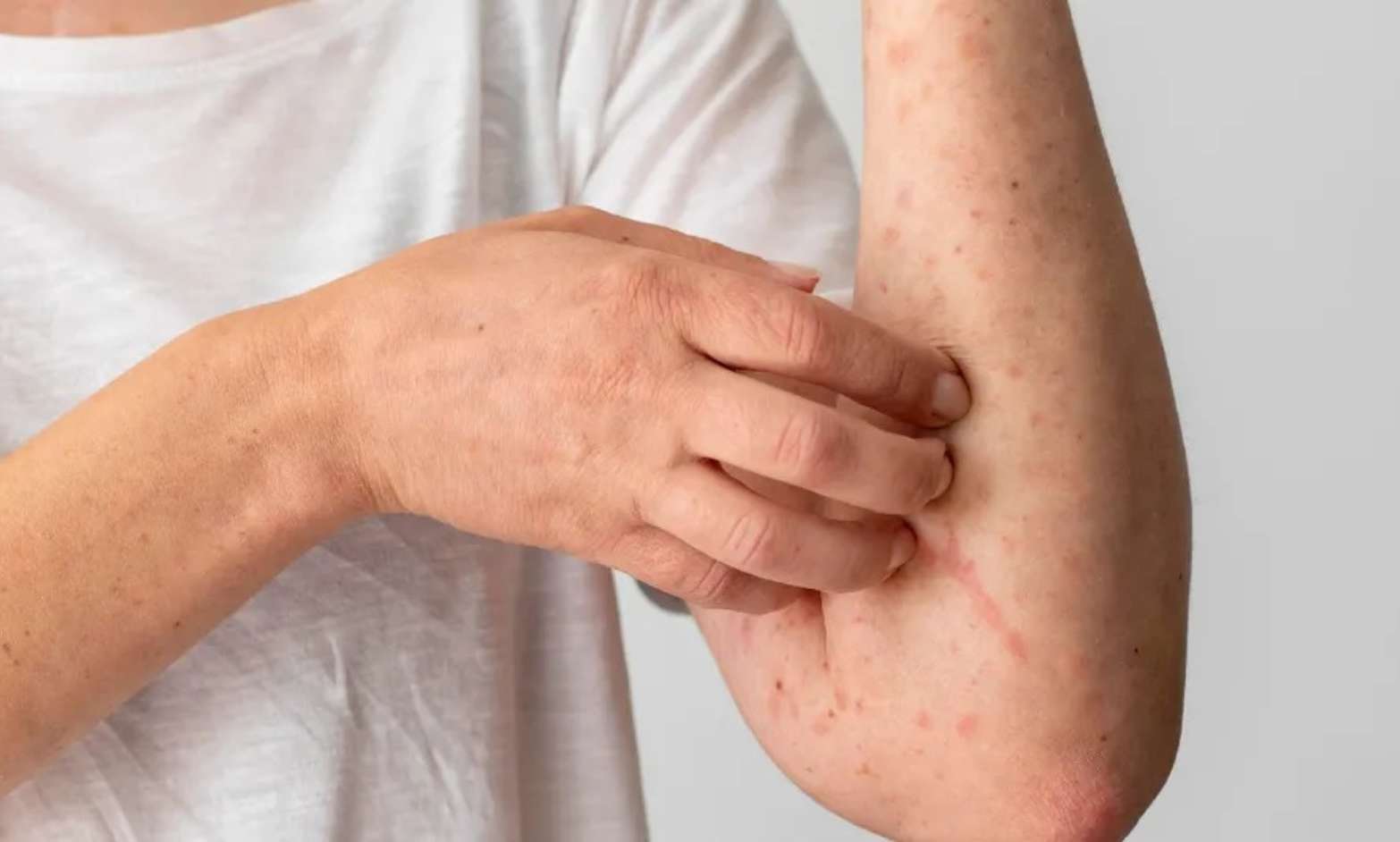 México acumula 24 muertes y casi seis mil casos de sarampión