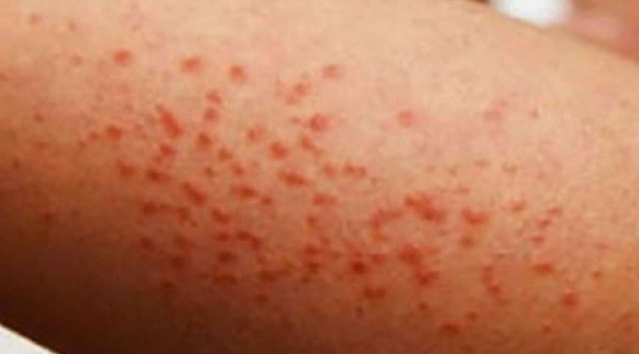 Salud confirma 7 mil nuevos casos de sarampión, 17 mil casos en todo México.