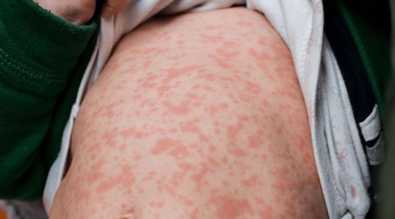 Suben a 28 las muertes por sarampión en México; confirman nuevo fallecimiento en CDMX