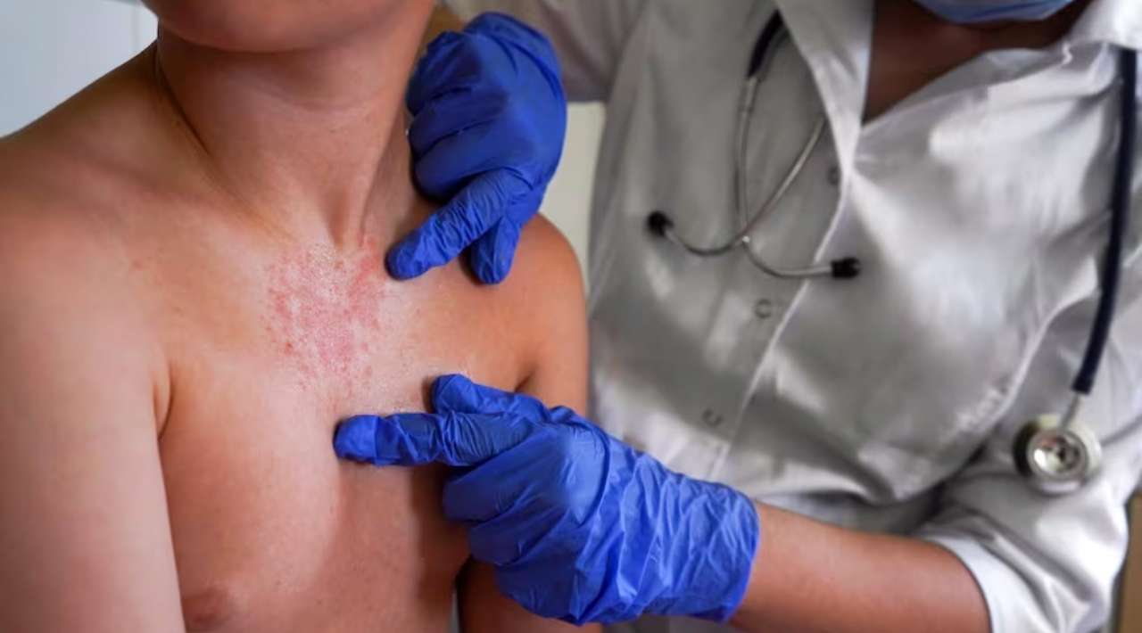 La Organización Panamericana de la Salud alerta por aumento de casos de sarampión en América